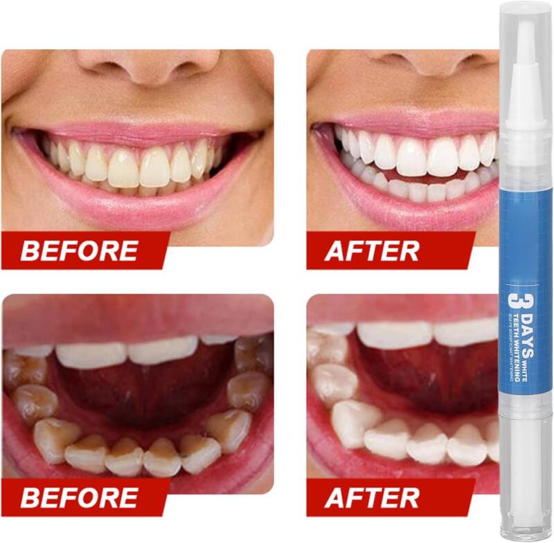 احصل على ابتسامة مشرقة مع قلم تبييض الأسنان Dazzling White. تجربة فعالة لتفتيح الأسنان والتخلص من البقع بسرعة. - novoloo